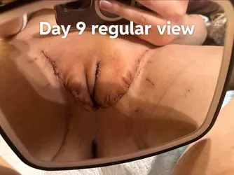 11-days-post-gcs-at-northwestern-with-dr-bowen-and-dr-jordan-v0-d9m53aufl2ne1.webp