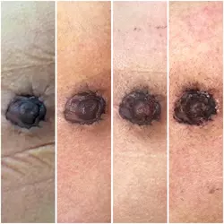 does-this-look-like-normal-healing-will-my-nipples-survive-v0-mx7yyfquq5ne1.webp