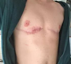 is-revision-possible-7-months-post-op-v0-54e6q73sa1ne1.webp