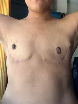 4-5-months-post-op-how-does-it-look-v0-3nut46f6e0ne1.webp