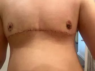 3-weeks-post-op-is-this-normal-v0-67etluooa3oe1.webp