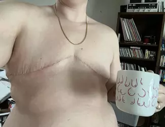 just-shy-of-4-weeks-post-op-v0-05x83axzxxne1.webp