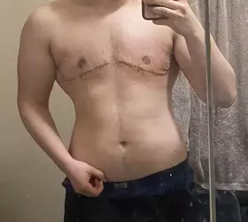 one-week-post-op-v0-3gj17mis6zne1.webp