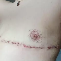 19-days-post-op-v0-3igr94stttne1.webp