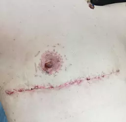 19-days-post-op-v0-ezh9lzotttne1.webp