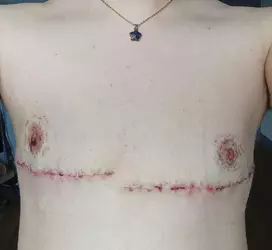 19-days-post-op-v0-90j4a9ltttne1.webp