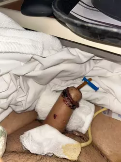 day-5-post-op-v0-f6uityeguune1.webp