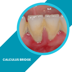 calculus-bridge-toothfeed.webp