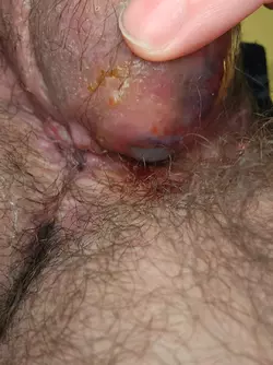 testicular-implant-erosion-v0-vyqc171vljoe1.webp