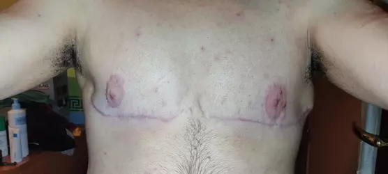 weird-post-op-chest-shape-when-bending-forward-v0-j5jvhfdf16oe1.webp