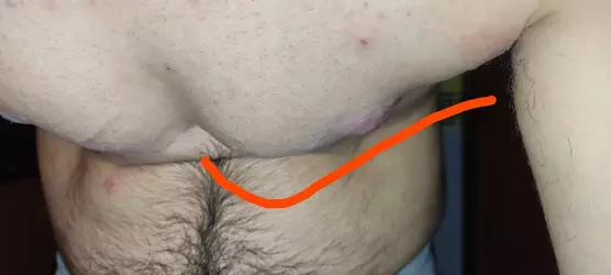 weird-post-op-chest-shape-when-bending-forward-v0-lj8n8l1f16oe1.webp