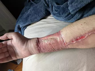 1-month-post-op-v0-2rxyxed5xxoe1.webp