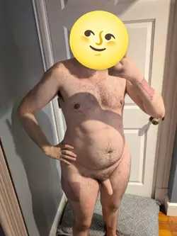 1-month-post-op-v0-yq5wq135xxoe1.webp
