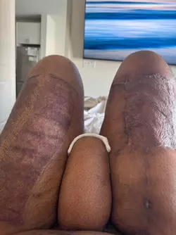 swelling-post-op-concerns-v0-lqpoebh3qwoe1.webp