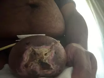 swelling-post-op-concerns-v0-xeg5fbh3qwoe1.webp