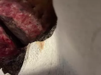swelling-post-op-concerns-v0-7qpikbh3qwoe1.webp
