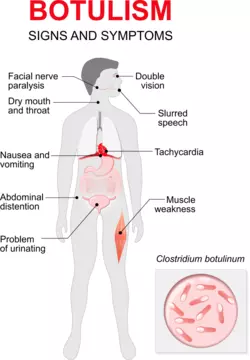 botulism-713x1024.png