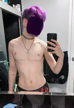 6-months-post-op-dr-mark-albert-ny-v0-bod9zrhln6pe1.webp