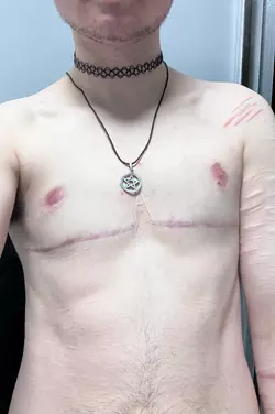6-months-post-op-dr-mark-albert-ny-v0-ps2llvhln6pe1.webp