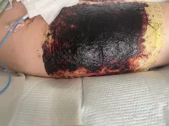day-4-post-op-rff-v0-h61l3snd26pe1.webp