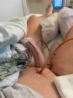 day-4-post-op-rff-v0-6ndttvmd26pe1.webp