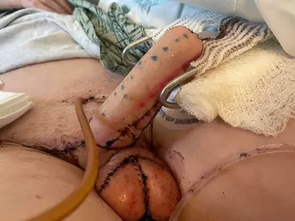 day-4-post-op-rff-v0-jcoxvumd26pe1.webp