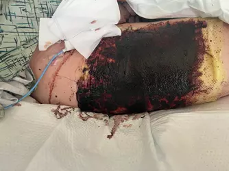 day-4-post-op-rff-v0-fyhtwumd26pe1.webp