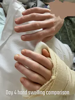 day-4-post-op-rff-v0-mo77qwmd26pe1.webp