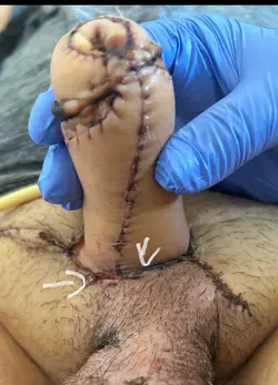 possible-wound-separation-starting-v0-jszfap9fripe1.webp