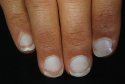 dermnet_photo_of_white_nails.jpg
