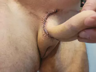 24-hours-post-op-scar-revision-v0-9pz1nf8fl4qe1.webp
