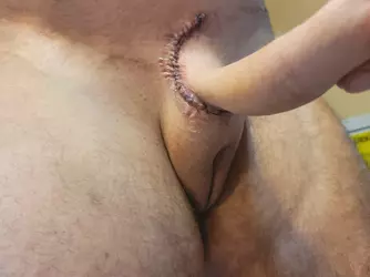 24-hours-post-op-scar-revision-v0-0hyro64fl4qe1.webp