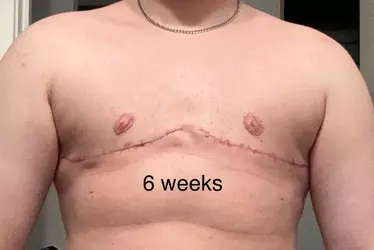 pre-op-to-6-weeks-v0-nnwanuqdccqe1.webp