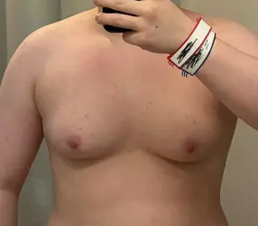 pre-op-to-6-weeks-v0-wtze6vqdccqe1.webp