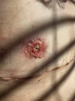 i-definitely-think-my-nipple-is-infected-v0-jkib52qrzgse1.webp