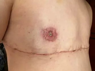 i-definitely-think-my-nipple-is-infected-v0-b8z7c0qrzgse1.webp