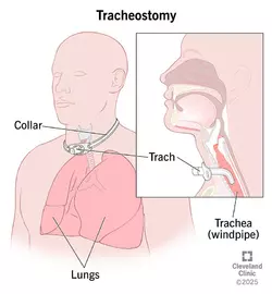 tracheostomy.jpg