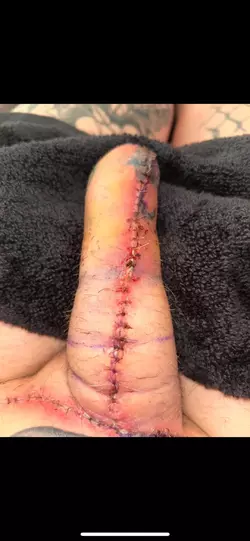 abdominal-phalloplasty-update-day-9-v0-sprphobsdhue1.webp