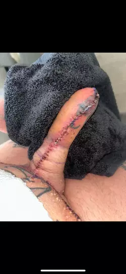 abdominal-phalloplasty-update-day-9-v0-f43kanbsdhue1.webp