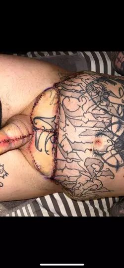 abdominal-phalloplasty-update-day-9-v0-9z8tanbsdhue1.webp