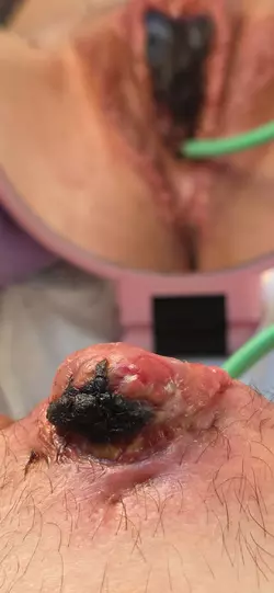 18-days-post-op-with-dr-nigriny-at-dartmouth-hitchcock-v0-6x54vtjtctue1.webp