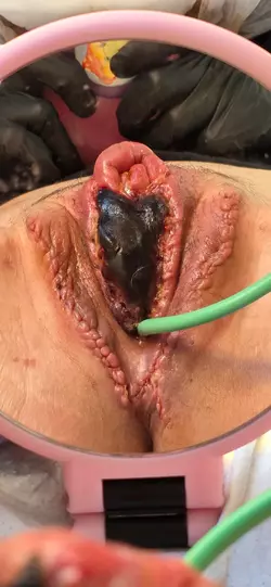 18-days-post-op-with-dr-nigriny-at-dartmouth-hitchcock-v0-vnyaq7htctue1.webp