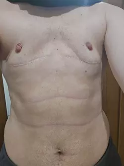 would-doing-a-revision-fix-this-i-feel-like-theres-breast-v0-04b7dap5hkue1.webp