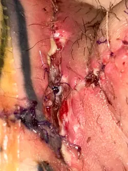 abdominal-phalloplasty-uk-stage-1-update-day-16-v0-kd3qqqchihve1.webp