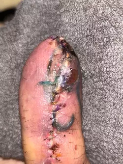 abdominal-phalloplasty-uk-stage-1-update-day-16-v0-x4s9frchihve1.webp