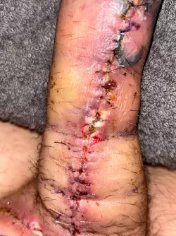 abdominal-phalloplasty-uk-stage-1-update-day-16-v0-les3xrchihve1.webp