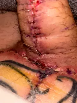 abdominal-phalloplasty-uk-stage-1-update-day-16-v0-snicaodhihve1.webp