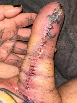 abdominal-phalloplasty-uk-stage-1-update-v0-djquk8skt8ve1.webp