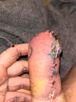abdominal-phalloplasty-uk-stage-1-update-v0-eqn2w8skt8ve1.webp