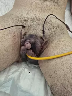 day-1-post-op-no-ul-no-vaginectomy-with-scrotoplasty-and-v0-cyvq2blsk0ve1.webp